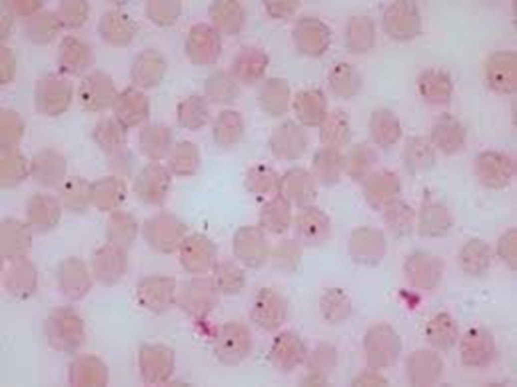 Anaplasmosis: An Ongoing Battle